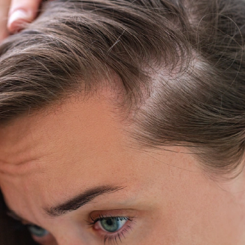 how to prevent hair loss in women